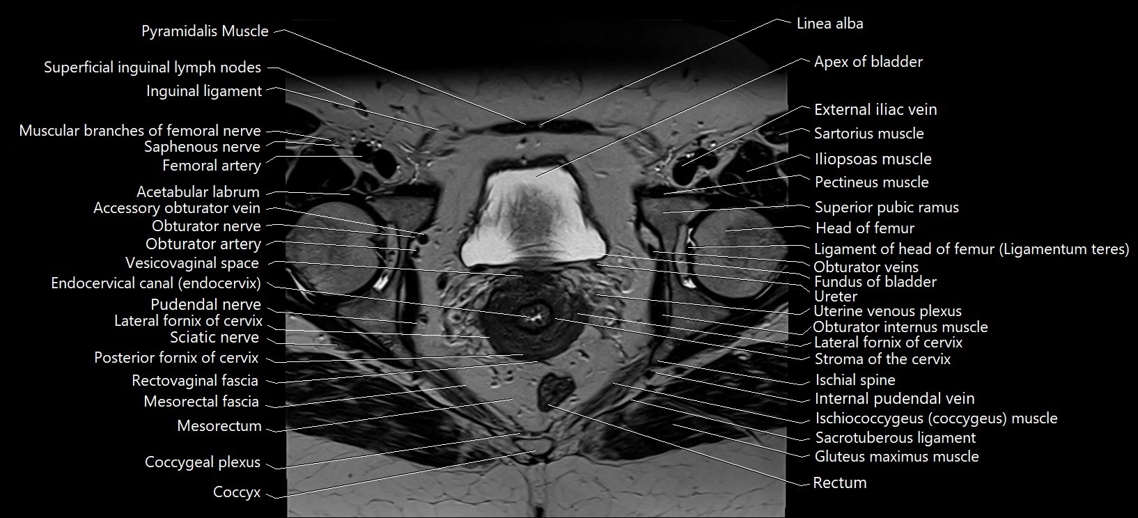 Axial cross sectional anatomy of female pelvis (MRI 3T) image 27.webp